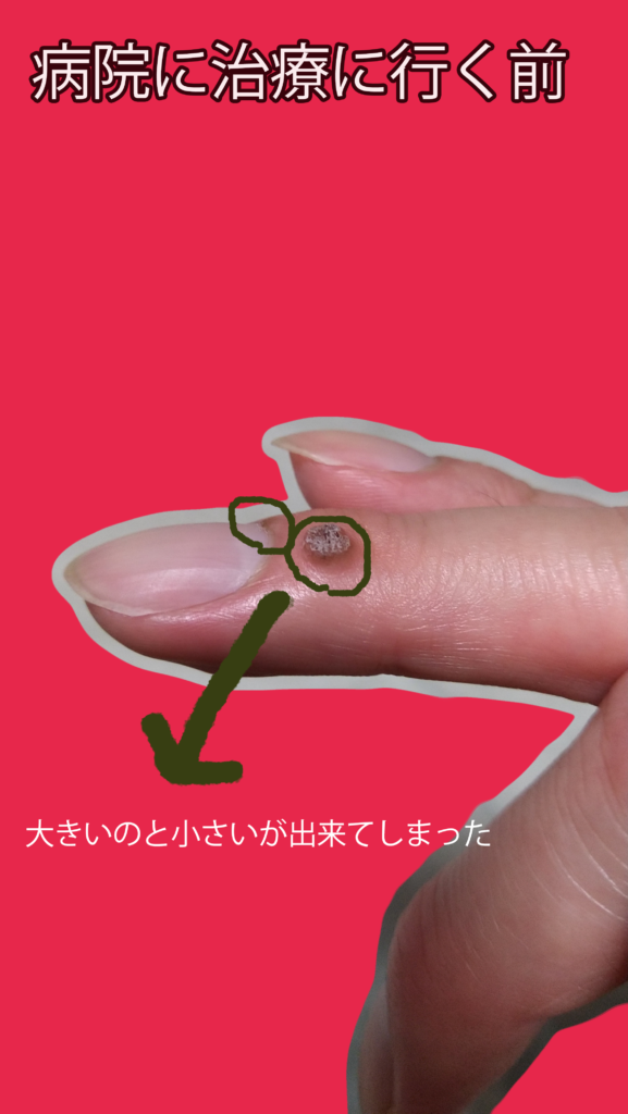 悪性イボの発症から治療の体験談