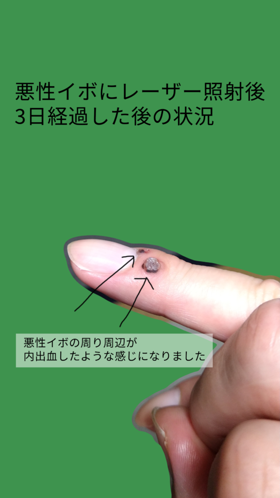悪性イボの治療の体験談