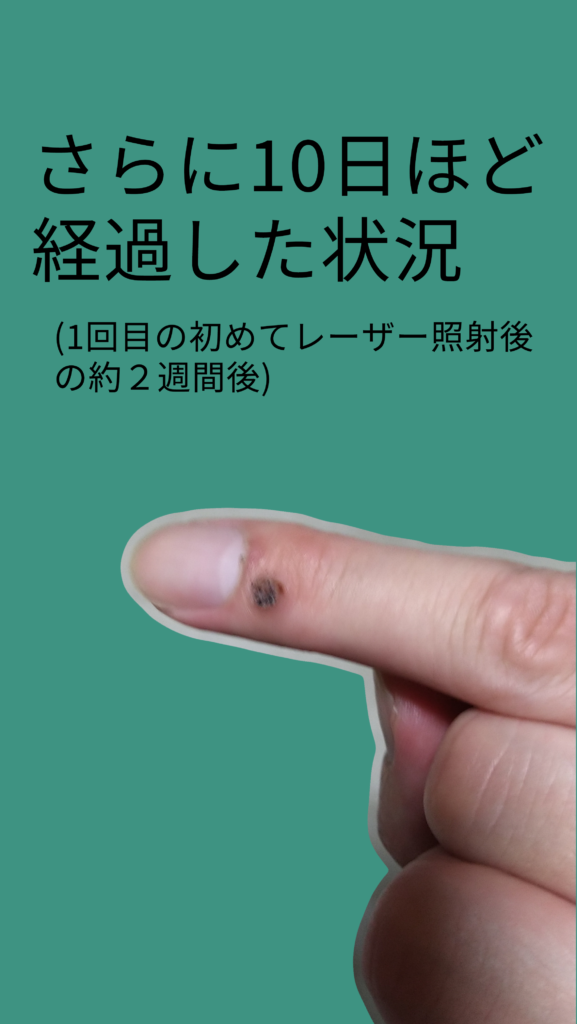 悪性イボの治療と体験談