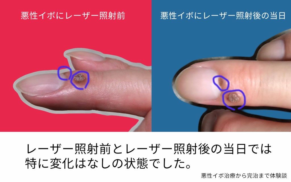 悪性イボの症状から治療 完治までの体験談